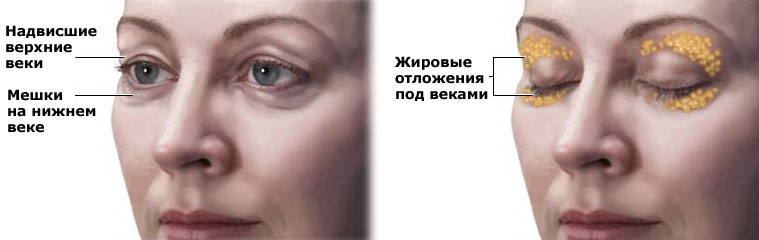 Трансконъюктивальная блефаропластика