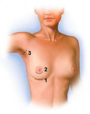 Виды доступа при введении имплантов